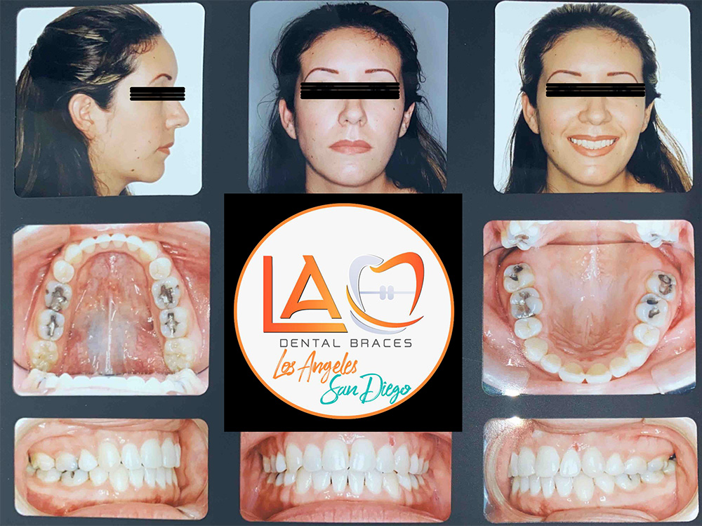 Before and After Photos LA Dental Braces